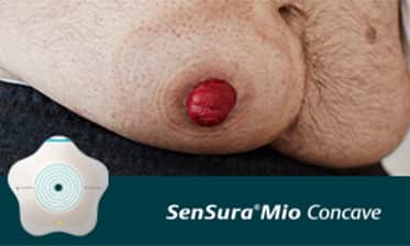 Is your stoma on an area with bulges and curves?